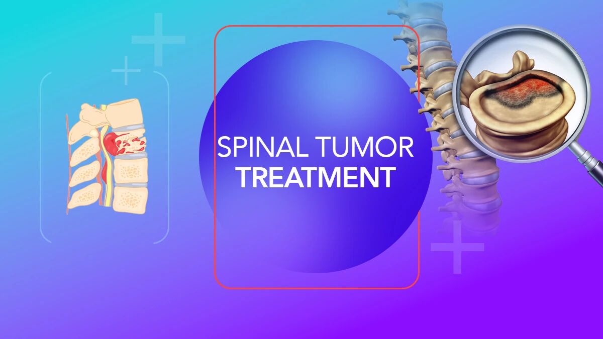 spinal-tumors-causes-symptoms-diagnosis-and-advanced-surgical-treatment-thumbnail
