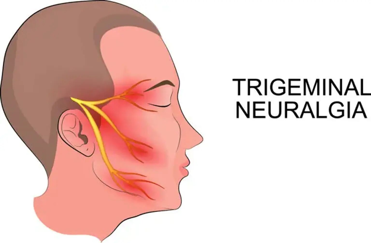understanding-trigeminal-neuralgia-causes-symptoms-and-treatment-thumbnail