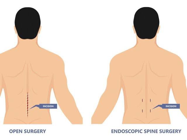 ಬೆನ್ನು ಹುರಿ ಶಸ್ತ್ರಚಿಕಿತ್ಸೆಯ ಹೊಸ ಯುಗ – ದೂರದರ್ಶಕ / ಚಿಕ್ಕ ರಂಧ್ರ (Keyhole Spine Surgery in Hubli, Dharwad, North Karnataka, India)