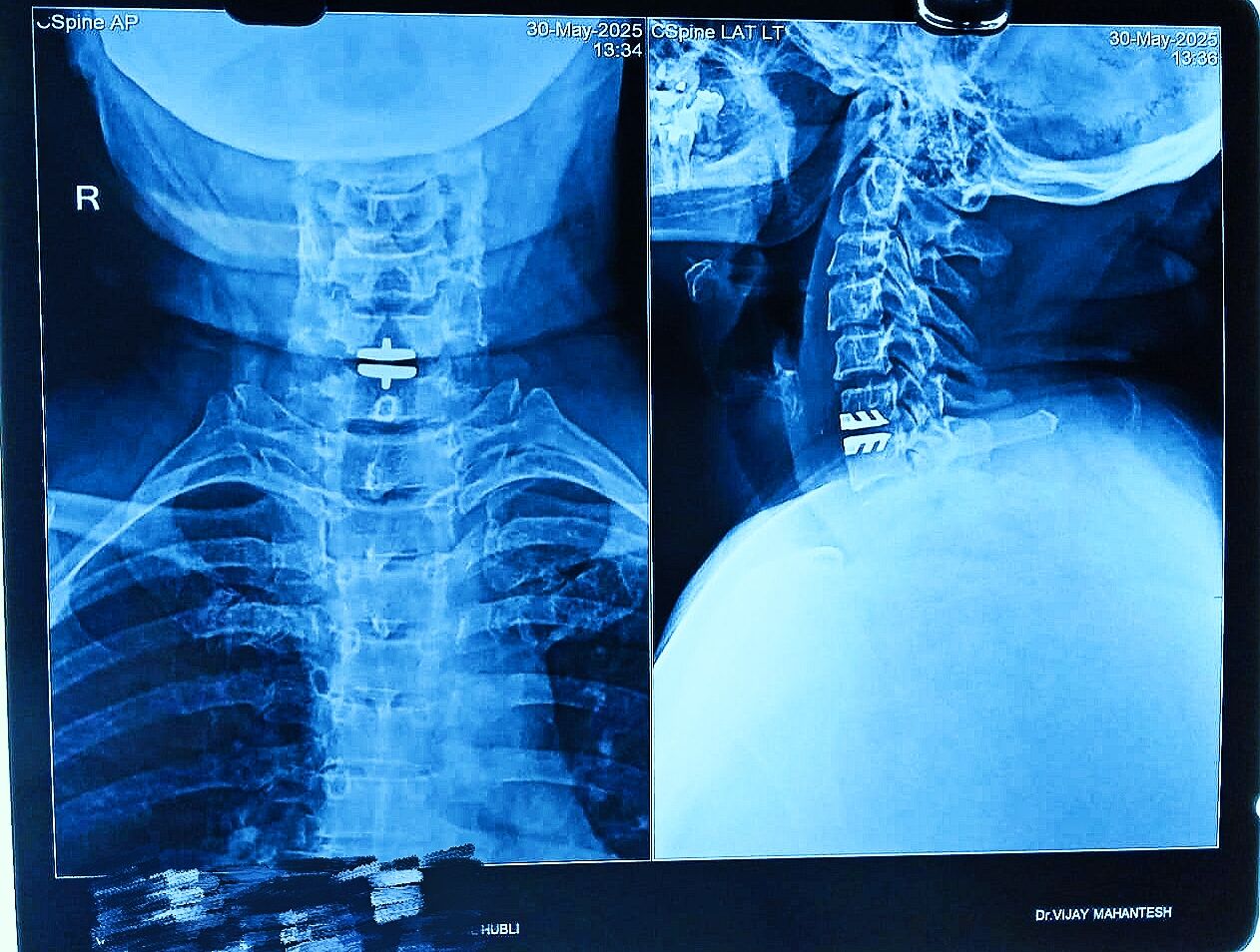 First Artificial Cervical Disc Replacement Surgery in North Karnataka – Performed Successfully in Hubli